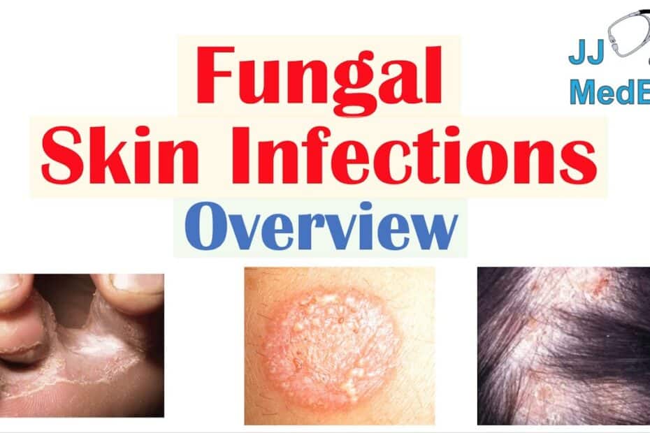Fungal Infection On Skin