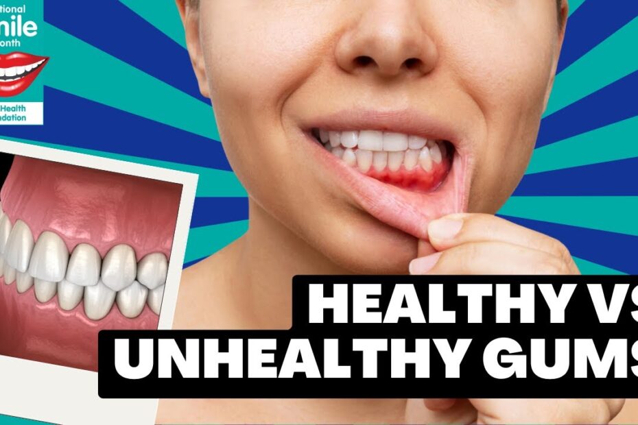 Early gum disease