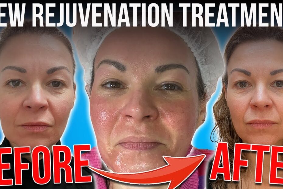 Exosomes microneedling